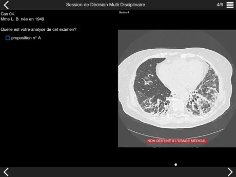 Fibrose pulmonaire 2017