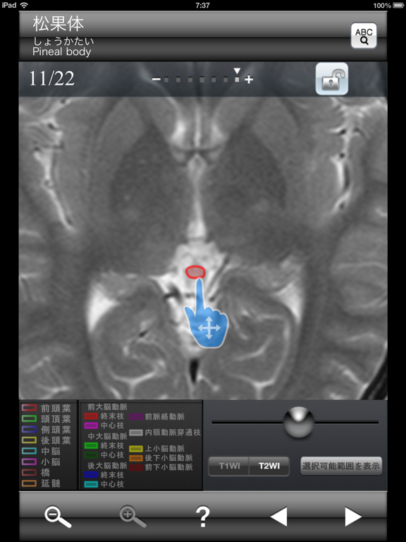 断面図ウォーカー脳MRIのおすすめ画像1