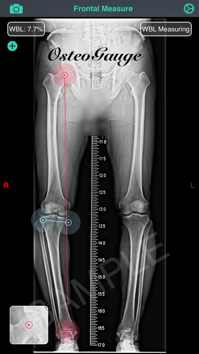 OsteoGauge - lower limb Screenshot