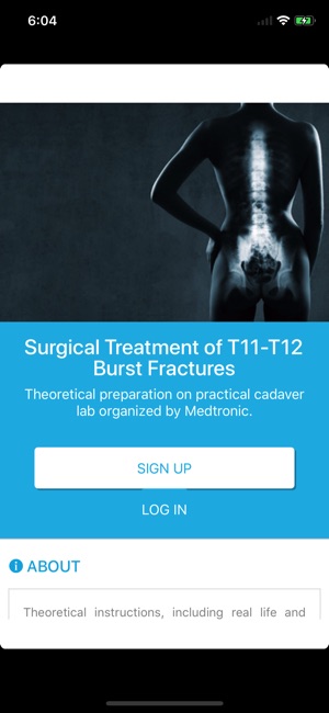 Thoracolumbar Burst Fracture