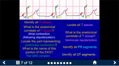 EKG - SecondLook iPhone image 3