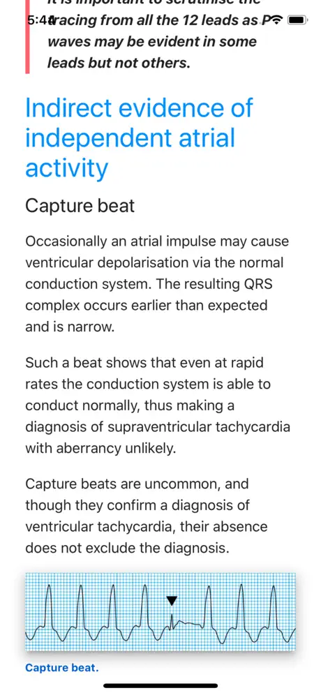 ECG Basics Lite: ECG Made Easy
