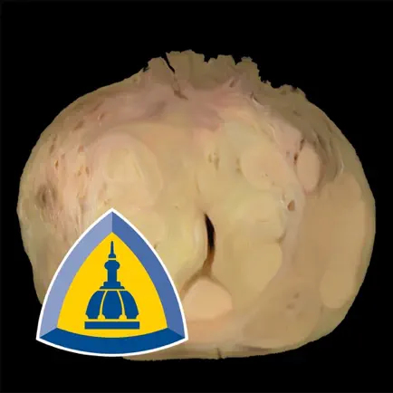 Hopkins Prostate Pathology Cheats
