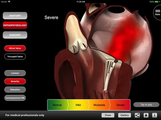 Mitral & Tricuspid Valves iPad screenshot 3 - Medical app
