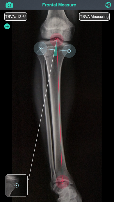 OsteoGauge - lower limb Screenshot