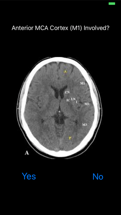 Screenshot #2 pour ASPECTS Score Calculator