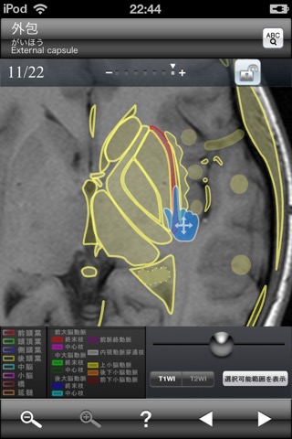 断面図ウォーカー脳MRIのおすすめ画像4