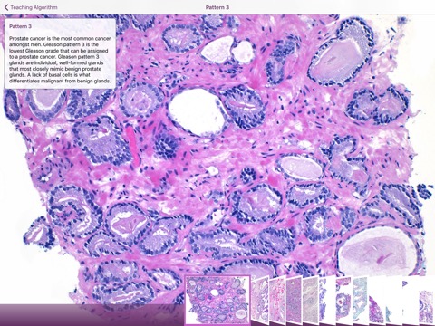 Hopkins Prostate Pathologyのおすすめ画像3