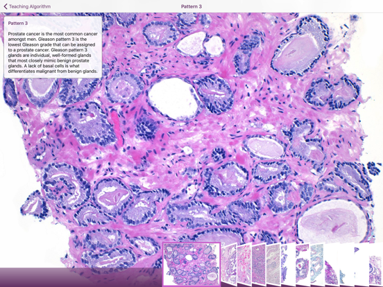 Screenshot #6 pour Hopkins Prostate Pathology