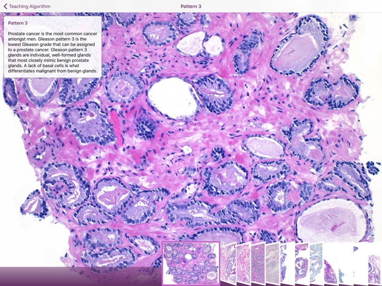 Hopkins Prostate Pathology