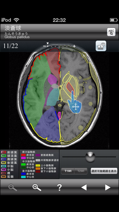 断面図ウォーカー脳MRI screenshot1