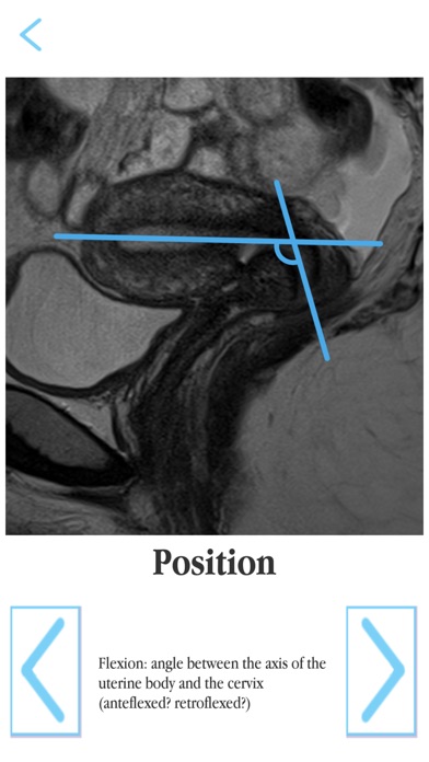 Female pelvis MRI RSNA screenshot 4