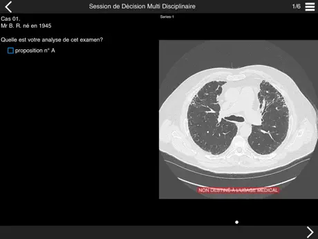 Fibrose pulmonaire 2017