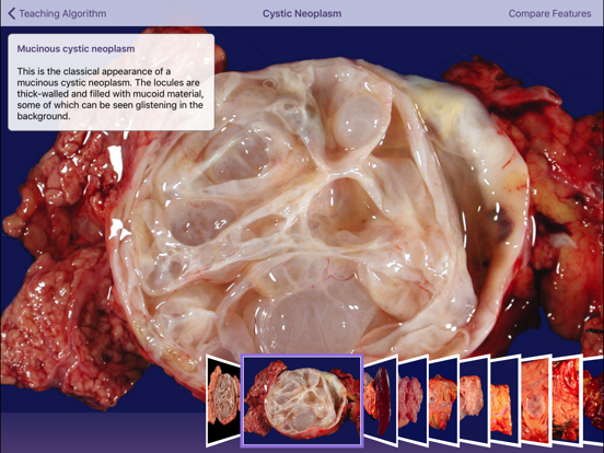 Screenshot #6 pour Johns Hopkins Atlas of Pancreatic Pathology