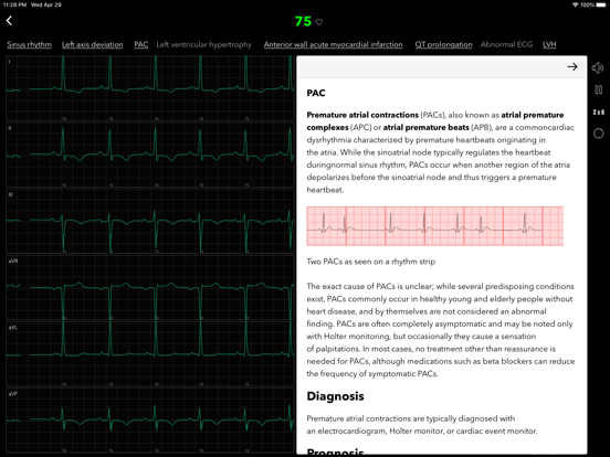 ECG for Doctors iPad screenshot 4 - Medical app