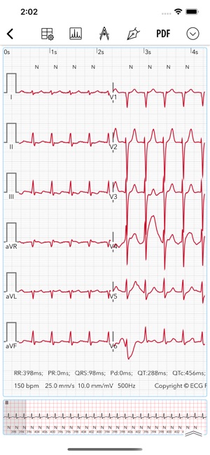Normal Sinus Apple Watch Ecg Normal How To Set Up Your Apple