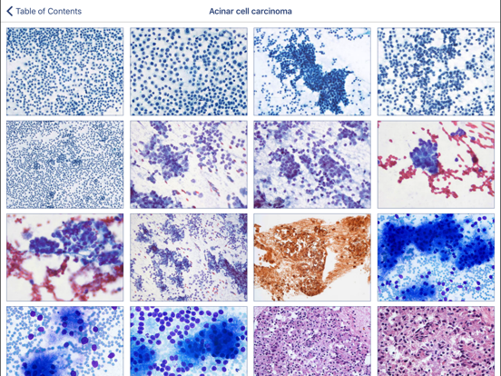 Screenshot #5 pour Johns Hopkins Atlas of Pancreatic Cytopathology