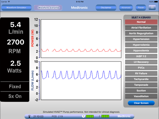 HVAD Waveforms iPad screenshot 4 - Medical app