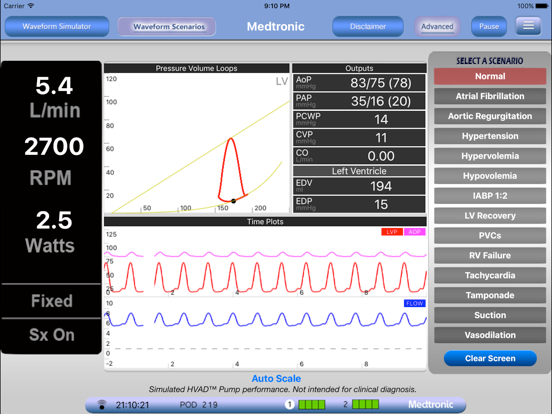 HVAD Waveforms iPad screenshot 5 - Medical app