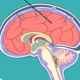 Hydrocephalus Procedure