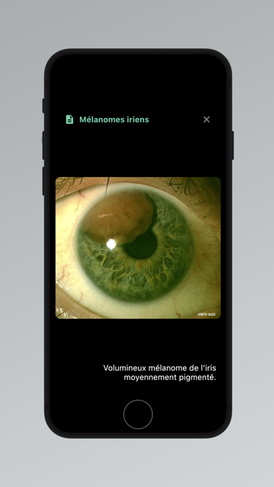 Tumeurs Oculaires Screenshot