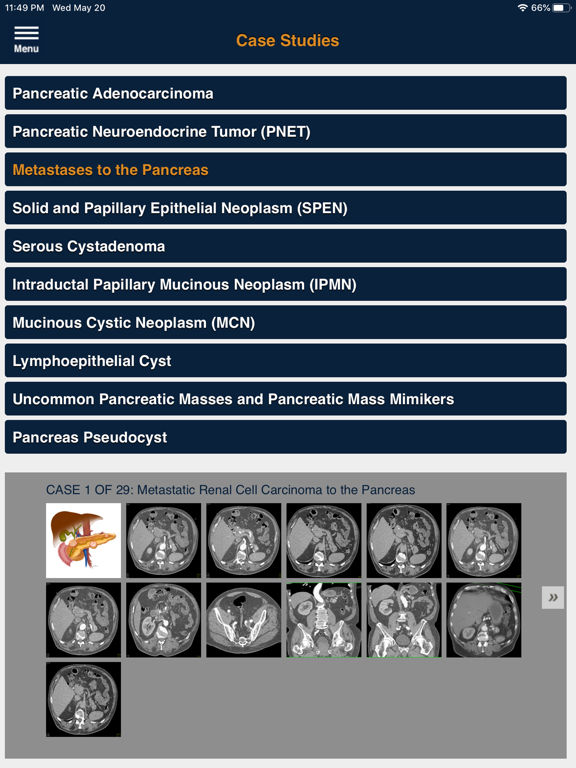 CTisus Pancreas Compendiumのおすすめ画像5