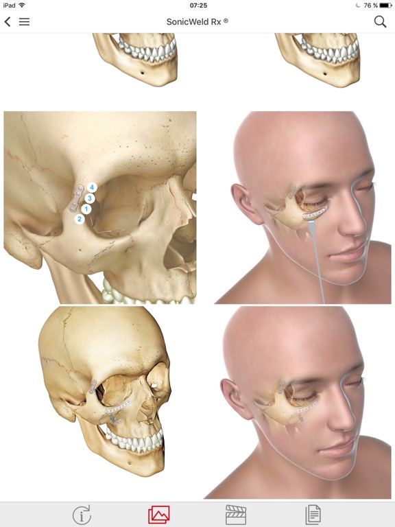 Screenshot #6 pour KLS Martin CMF Implants