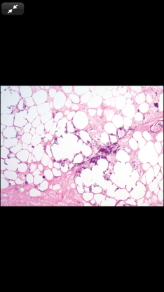 Anatomic Pathology Flashcards screenshot 5