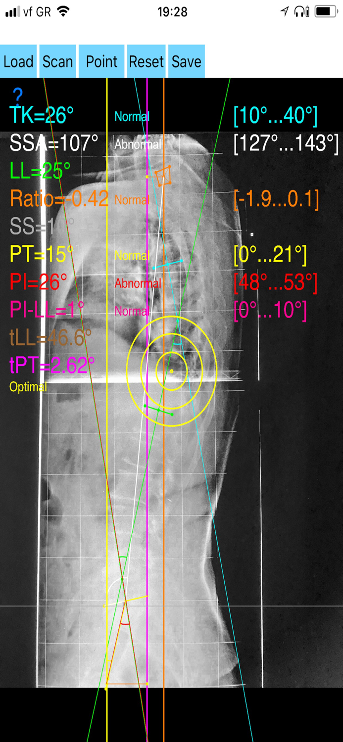 SagittalBalanceApp
