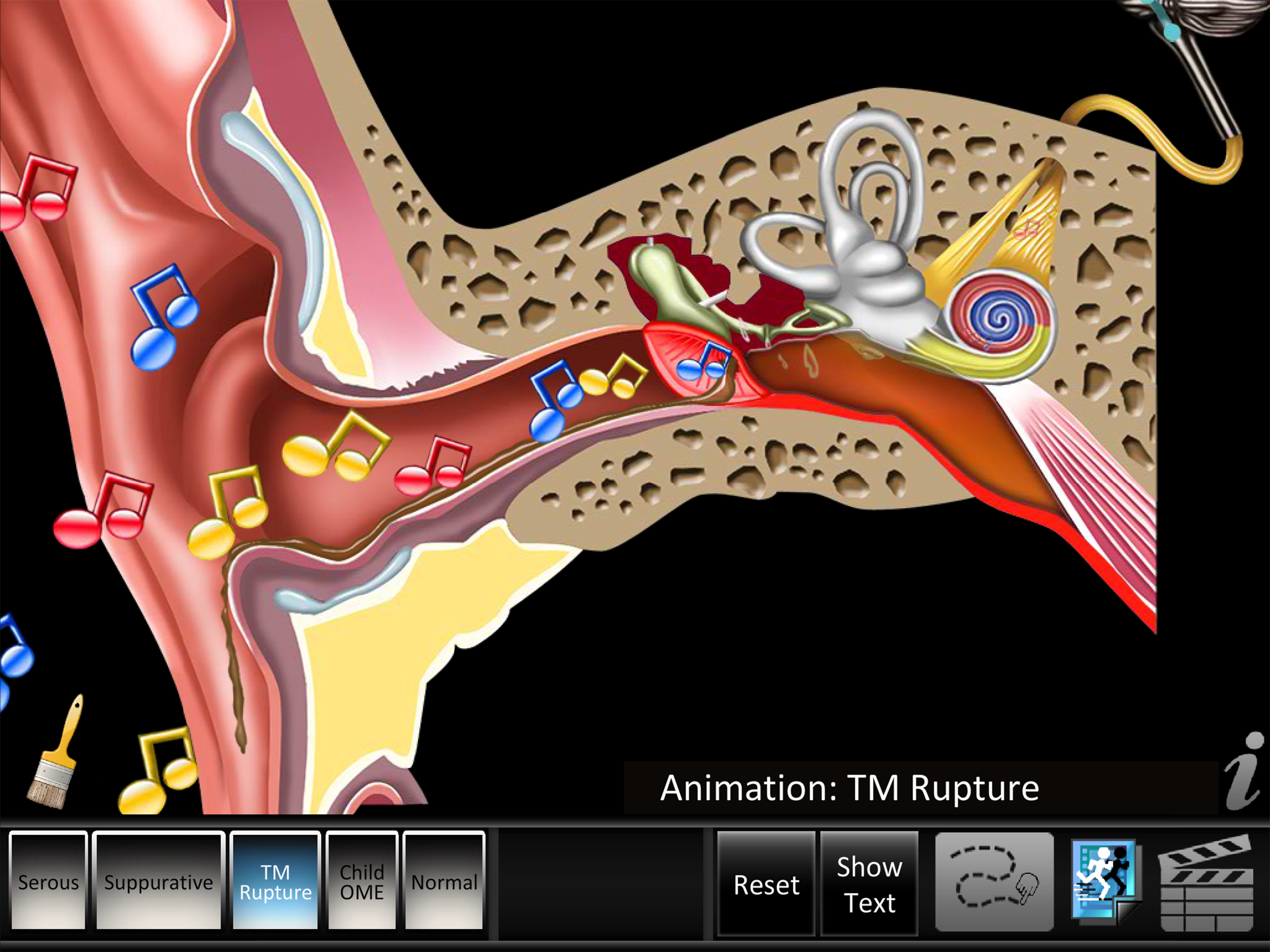 Otitis Media Disorders screenshot 9