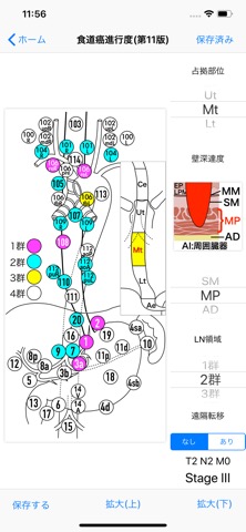 肝硬変重症度Child分類・消化器癌進行度分類のおすすめ画像2