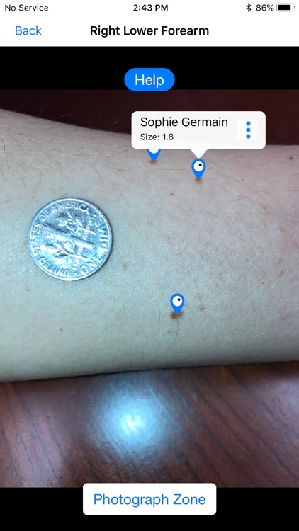 Mole Mapper Melanoma Study screenshot-3