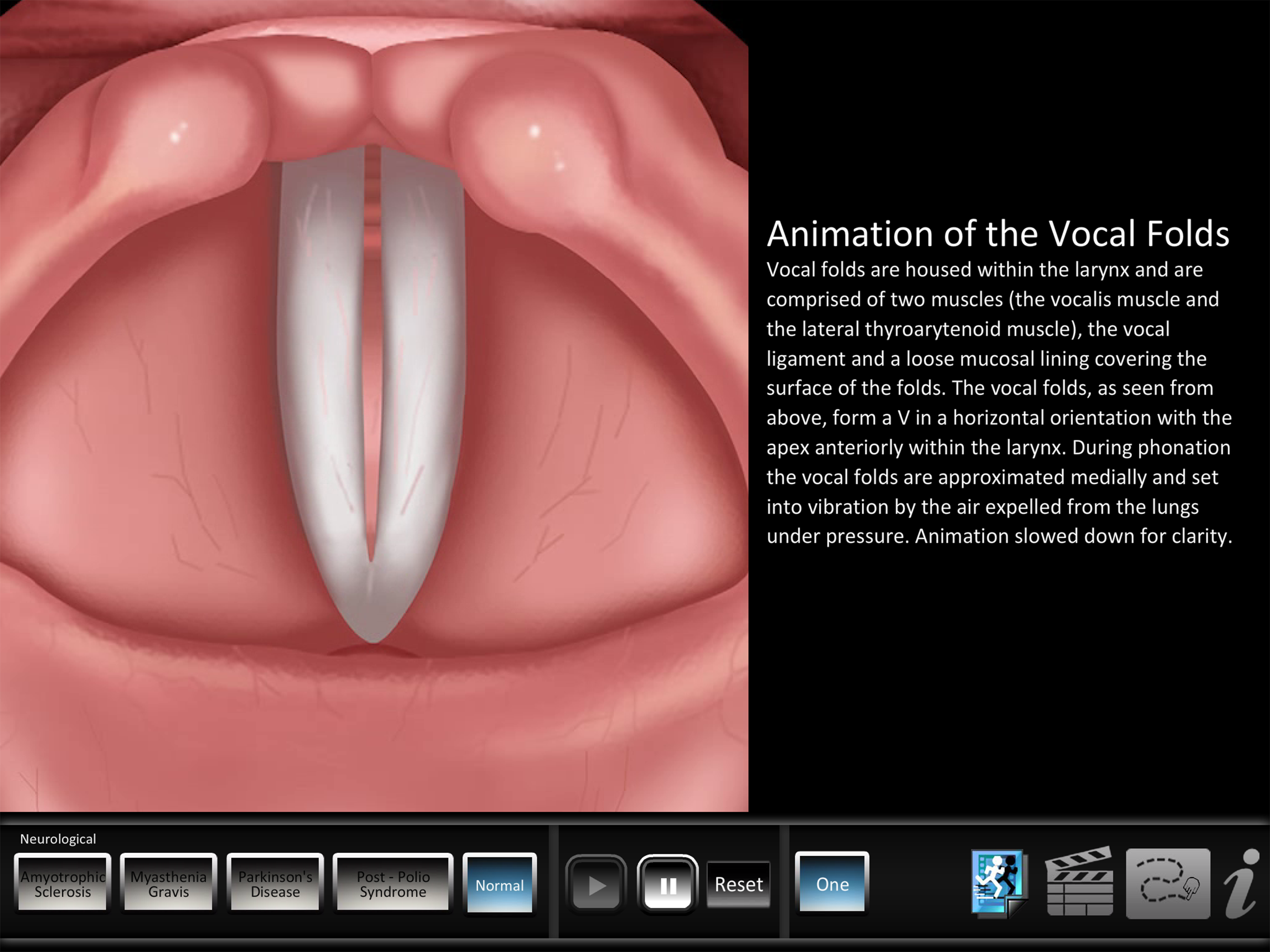 Vocal Pathology: Neurological screenshot 10