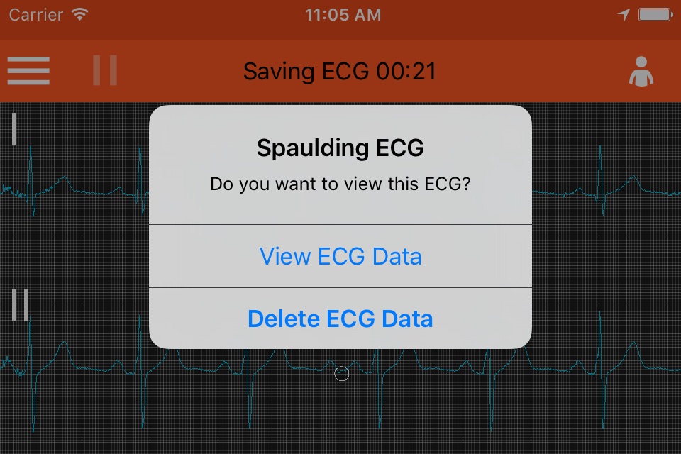 Spaulding ECG screenshot 2