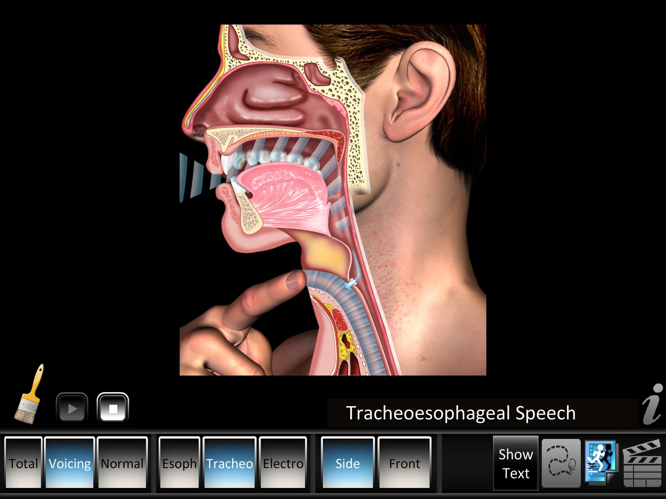 Laryngectomy