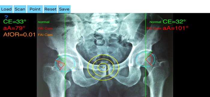 FemoroAcetabularImpingementApp