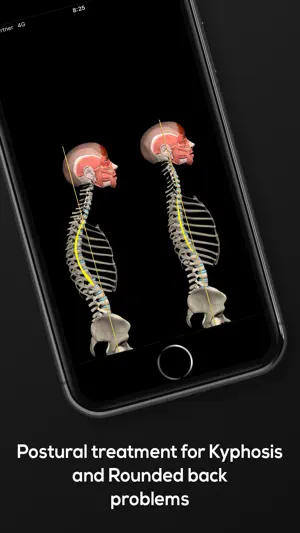 Muscle & Motion: Kyphosis screenshot 4
