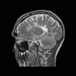 Understanding MRI MS