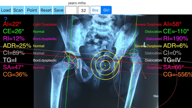 HipDysplasiaApp screenshot-3