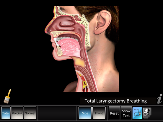 Screenshot #4 pour Laryngectomy