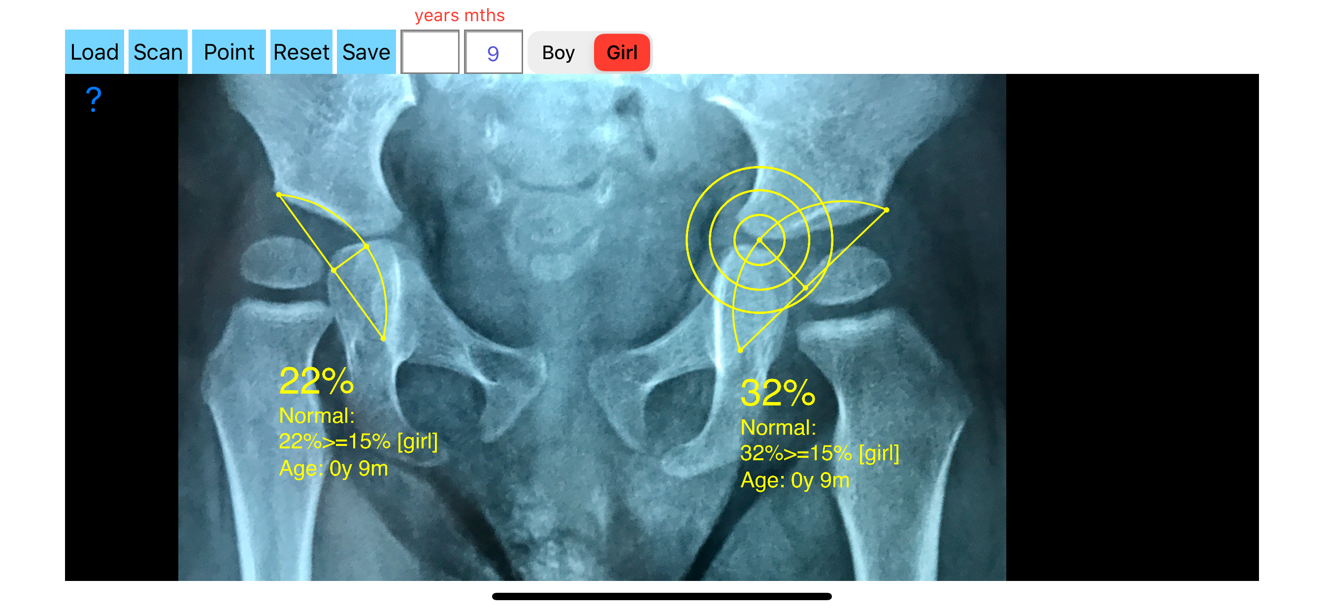 AcetabularDepthRatioApp screenshot 5
