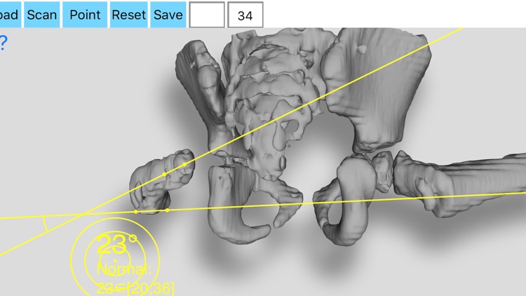 FemoralAnteversionApp