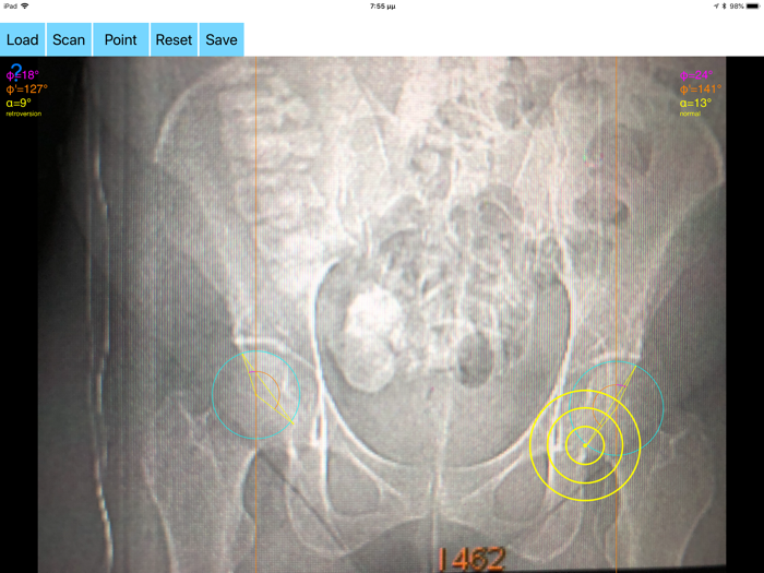 AcetabularAnteversionApp