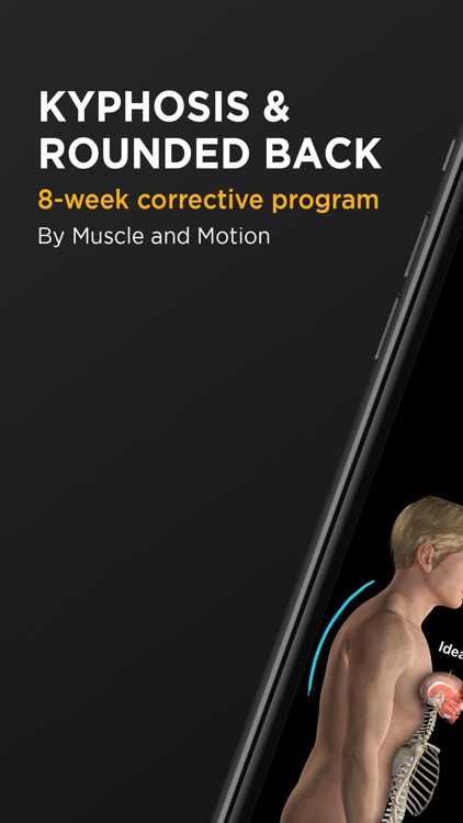 Kyphosis & Rounded Back