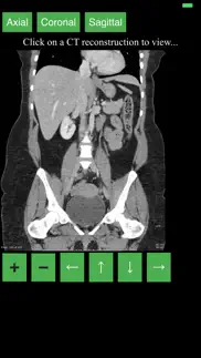 ct abdomen pelvis iphone screenshot 2