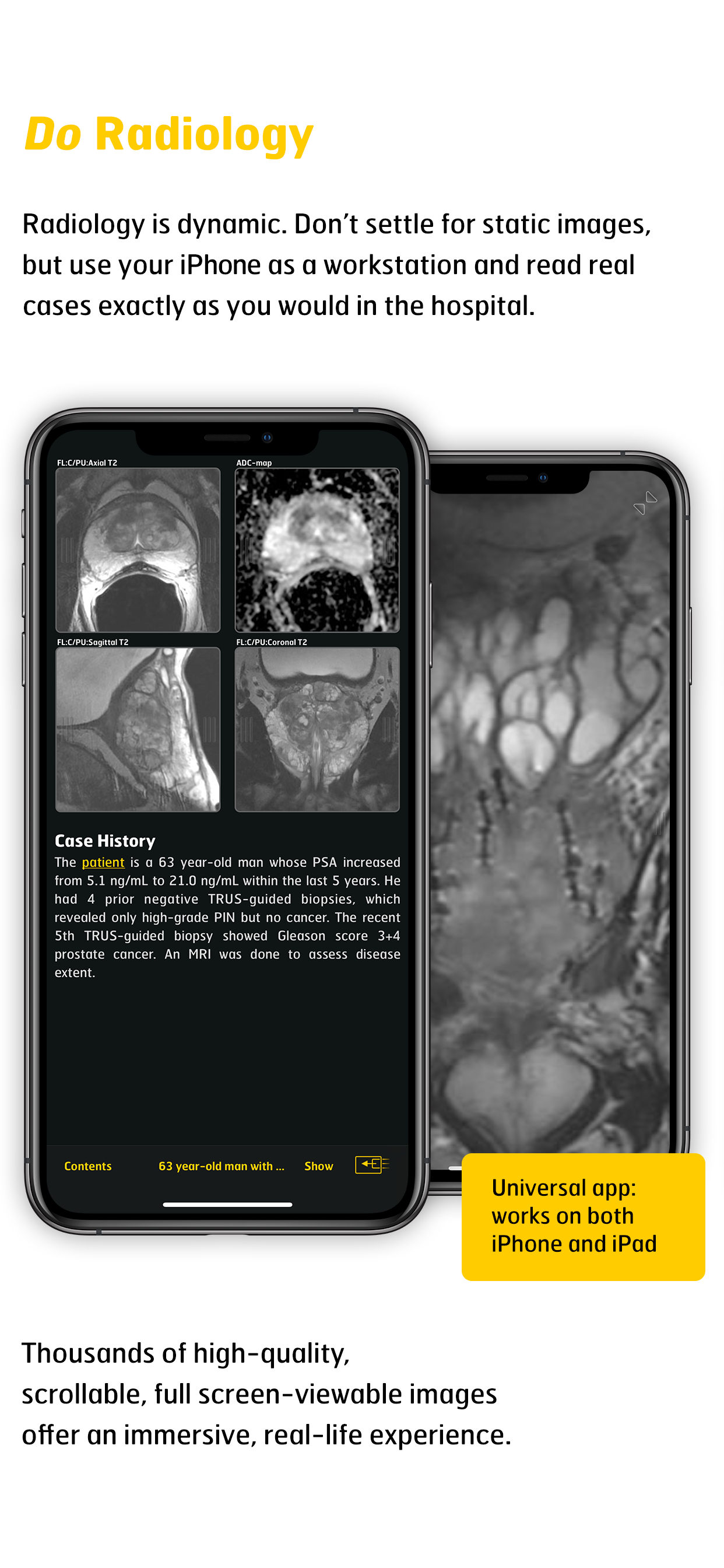 MR Imaging in Prostate Cancer