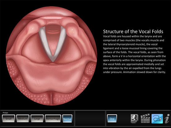 Screenshot #4 pour Vocal Pathology: Polyps