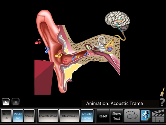 Screenshot #5 pour Ear Disorders: Outer Middle