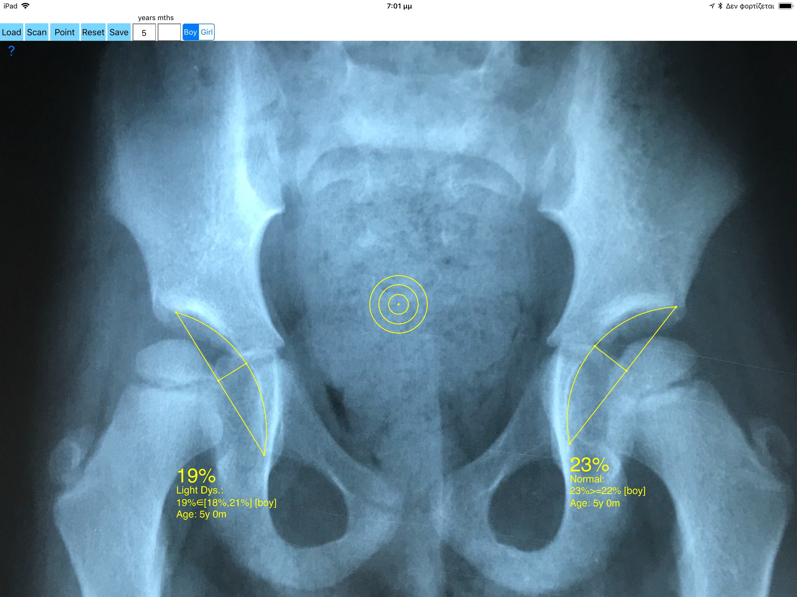 AcetabularDepthRatioApp screenshot 14