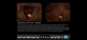 Vocal Pathology: Polyps screenshot #3 for iPhone